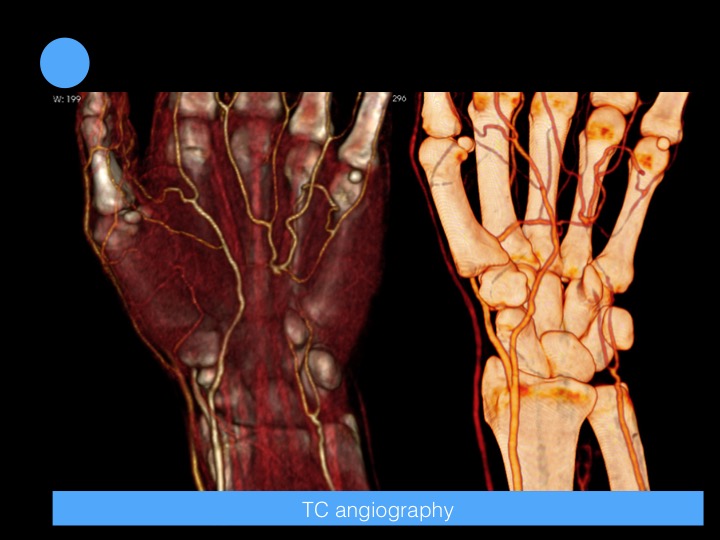 Figure 3 for case Hypothenar Hammer Syndrome